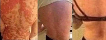 scoliosis 3