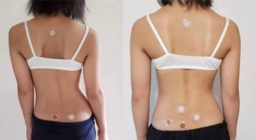 scoliosis 3